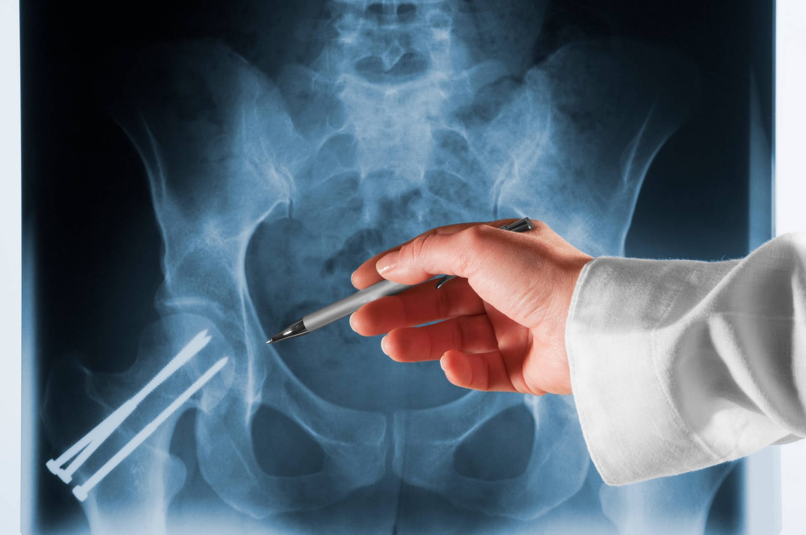 Neuraxial vs. General Anesthesia for Hip Fracture Repair