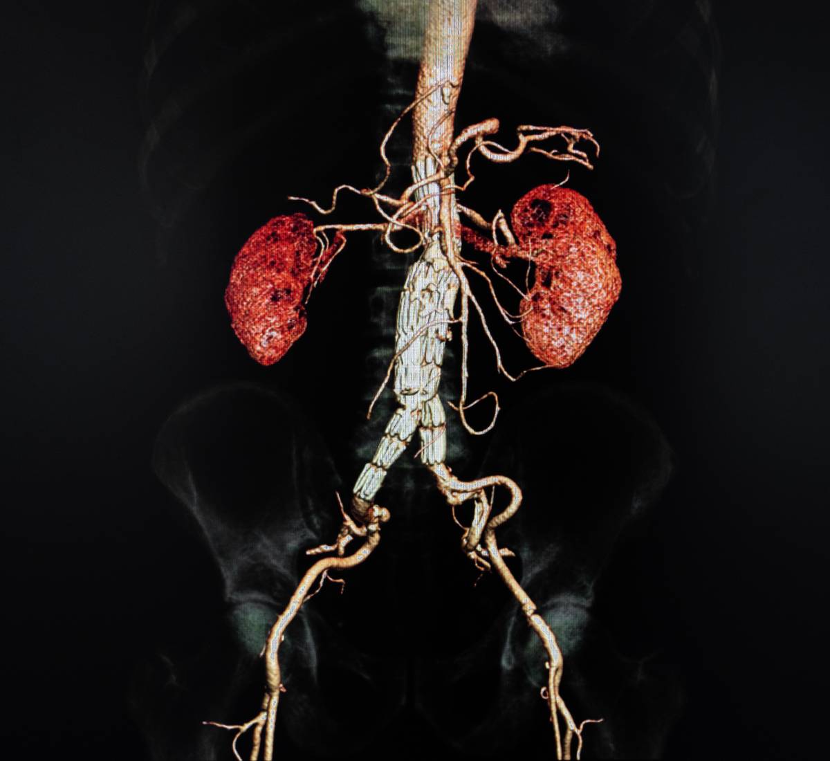 Intraoperative Hyperoxia and Acute Kidney Injury